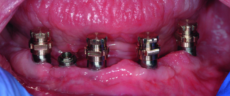 Fig. 13: SynCone caps are fitted to the abutments to verify unobstructed and complete seating.