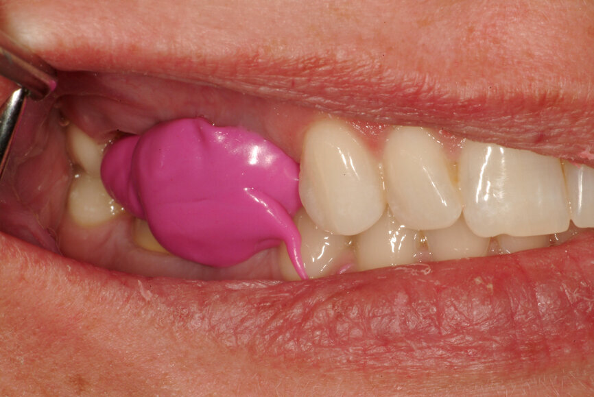 Fig. 19: Occlusal record limited to the prepared tooth area (when existing intercuspation is not altered).