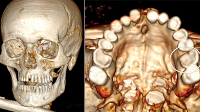 “IJsman” had rampzalig gebit