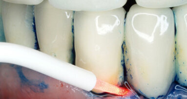 La terapia fotodinamica antimicrobica nel trattamento della perimplantite