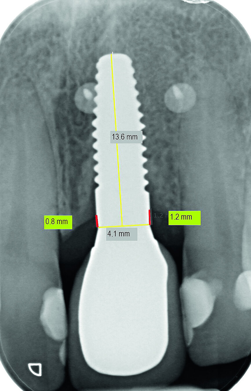Fig. 13c: Bone resorption was detected after six months and bone gain after 12 months. The yellow line represents the actual implant length (13.6mm). The red lines indicate the mesial and distal distances from the top of the implant to the first bone contact.