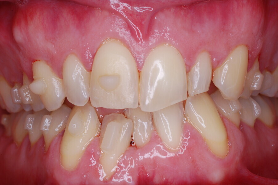 Fig. 25–28: Clinical progress after 12 months of aligner treatment.