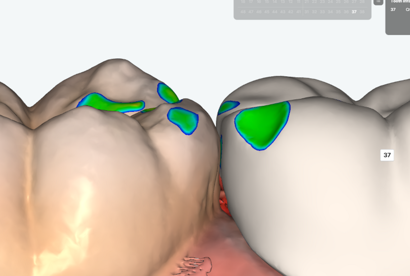 Fig. 5b: Occlusal surface refinement to optimise contact distribution.