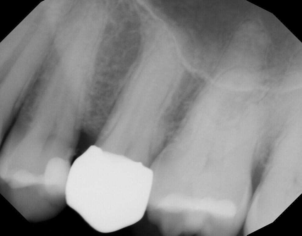 Fig. 9: Periapical radiograph taken four weeks after restoration placement, demonstrating an absence of periapical pathology.
