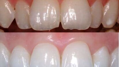 Inman Aligner: Korigovanje položaja zuba, beljenje i izrada direktnih adhezivnih restauracija – progresivni pristup preoblikovanju izgleda osmeha (Drugi deo)