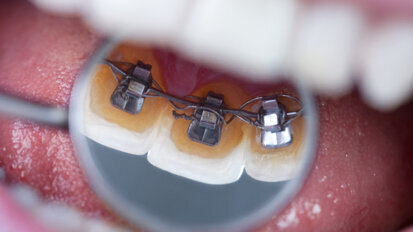 Neuentwicklung zur Säuberung von Zahnspangen Neuentwicklung zur Säuberung von Zahnspangen