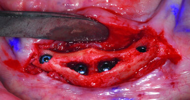 Brain-guided implant reconstruction: Who makes the decisions?