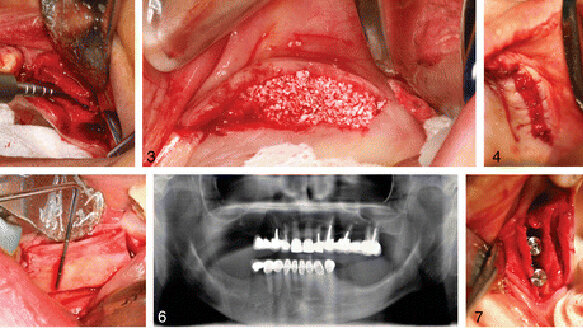Established ridge-split procedure offers new application in implant surgery