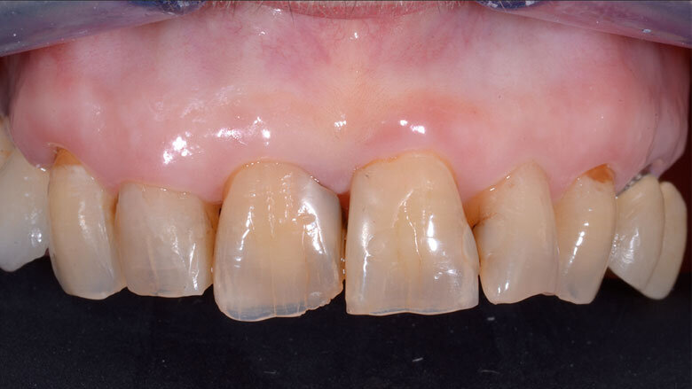 Fig. 1a - Valutazione pre-operatoria - visione frontale: l’elemento 1.1 è sintomatico e mostra segni e sintomi di pulpite irreversibile.