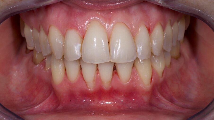 Fig. 10 - Post igiene dentale e trattamento con airpolishing.
