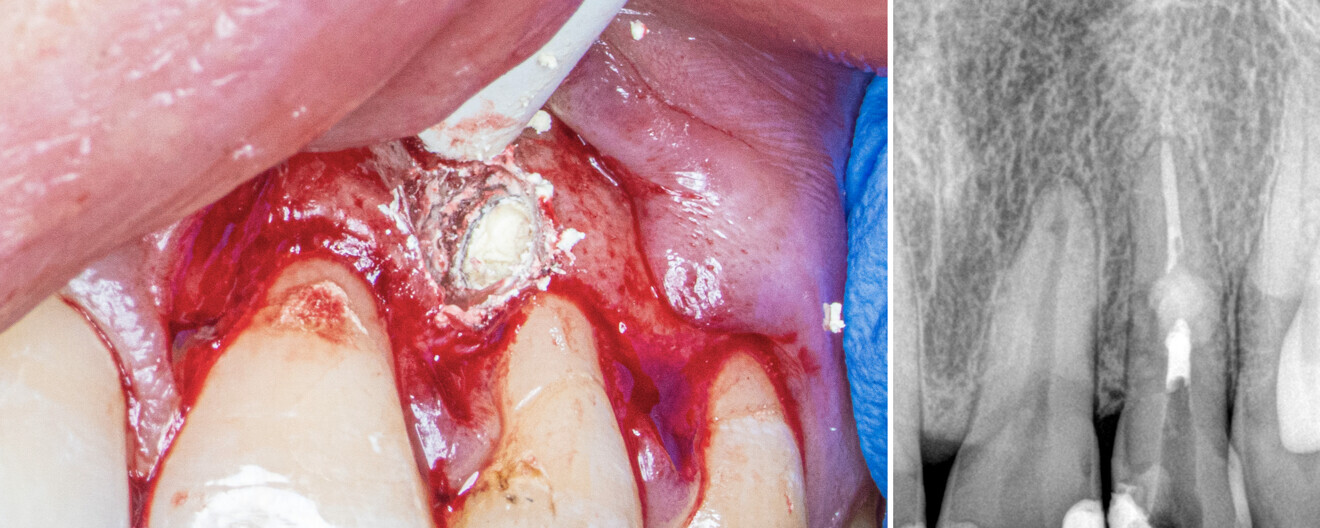 Figs. 4a & b: Biodentine filling the resorption cavity. Clinical (a) and radiographic view (b).