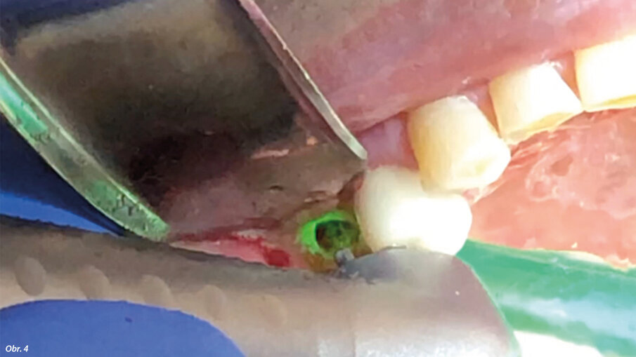 Odklopení laloku bylo provedeno Prichardovým elevátorem.