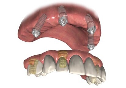 DIEM 2: Solutions for immediate full arch rehabilitation