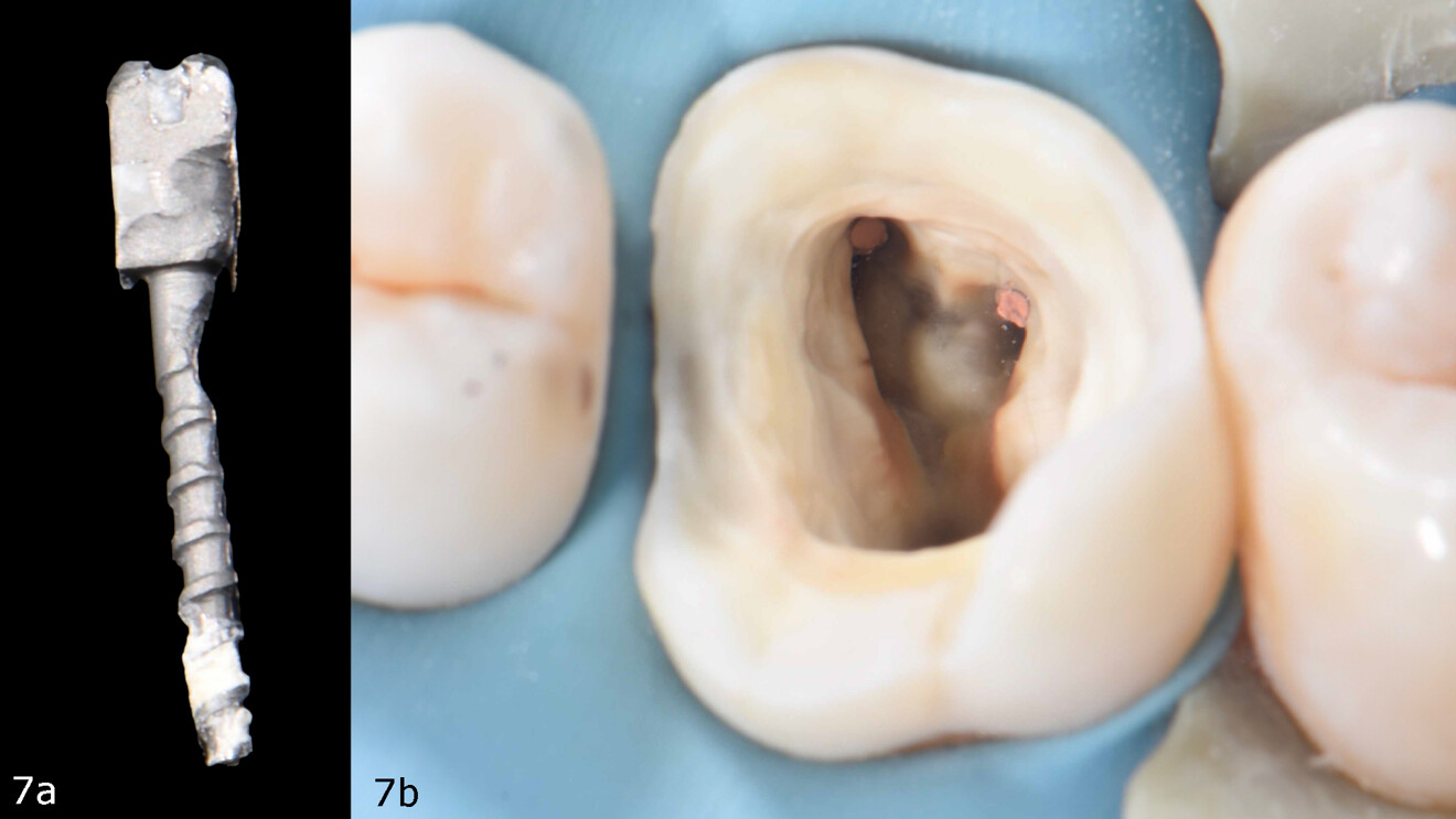 Figs. 7a & b: Post after removal (a). Cleaned cavity revealing an untreated second mesiobuccal canal and treated canals that appeared to have been insufficiently cleaned (b).