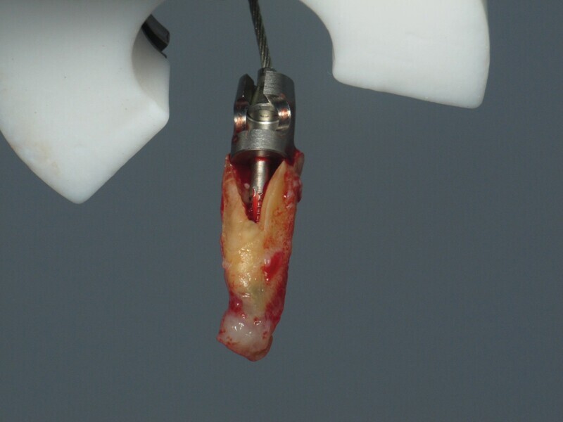 Fig. 19 : Extraction d‘une racine fracturée au Benex, par une force uniquement verticale. 