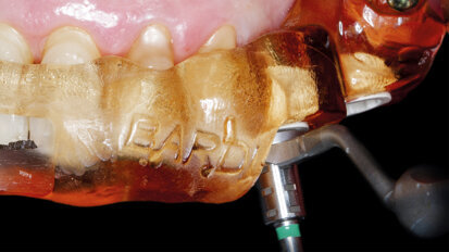 Tříčlenný můstek v distálním úseku na implantátech Straumann BLX s okamžitě nasazenou provizorní náhradou: kazuistika krok za krokem