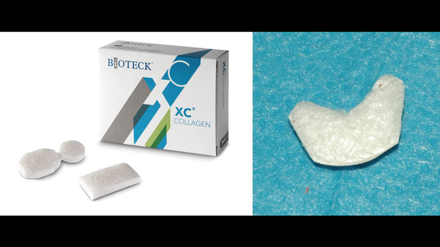 ; Fig. 6 - Matrice tridimensionale collagenica Xenomatrix (Xenomatrix, Bioteck Spa). Viene modellata a secco.