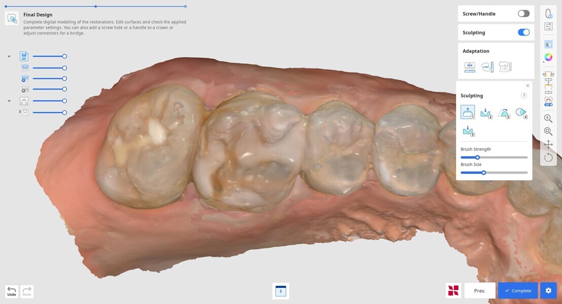 Fig. 5: Pre-op intra-oral scan in Medit ClinicCAD.