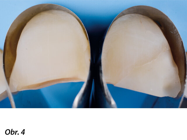 Střední řezáky s napreparovanými ploškami.