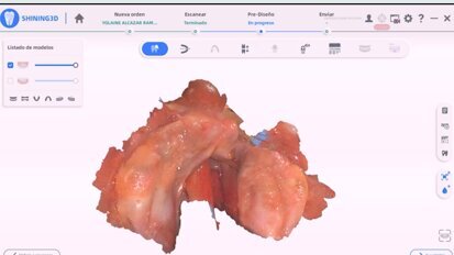 Labio y paladar fisurado Jesus video5