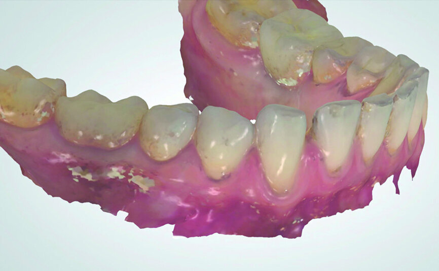 Fig. 2: TRIOS 3 color (3Shape) pre-scan.