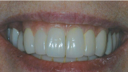 Utilizing the ERA over-denture implant to create soft-tissue symmetry in the esthetic zone Utilizing the ERA over-denture implant to create soft-tissue symmetry in the esthetic zone