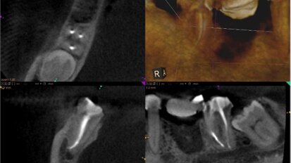 Efektywność wypełnienia kanałów w leczeniu endodontycznym z zastosowaniem CBCT
