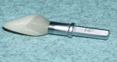 Remplacement immédiat d'une dent unitaire, provisionalisation