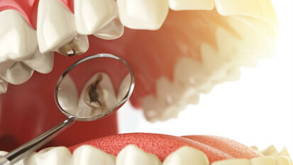 Prevenzione e management non restaurativo delle lesioni cariose