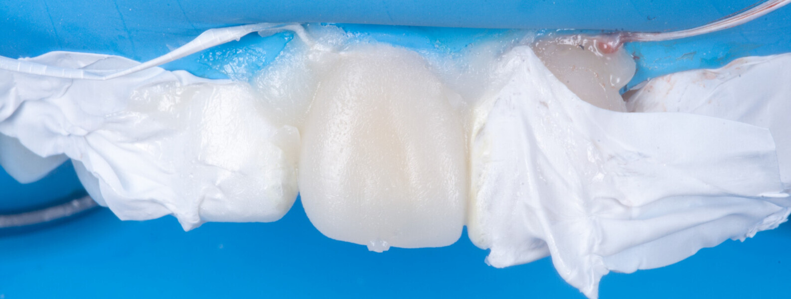 Fig. 20 : Résultat brut après injection.