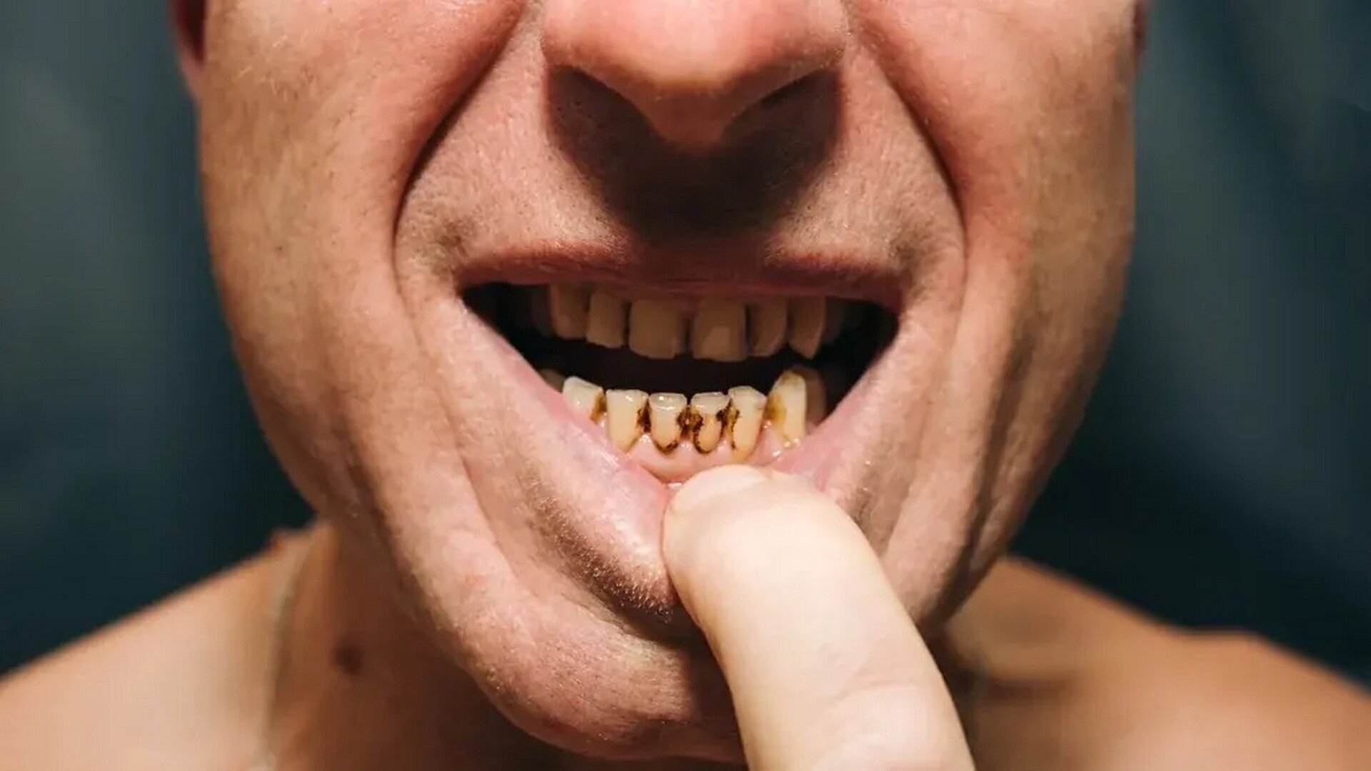 Cena je hlavním faktorem neuspokojených potřeb v oblasti zubní péče v zemích EU