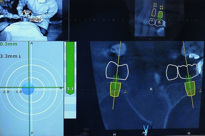 Fig. 8: Navident provided visual confirmation of the position of the drill tip to accurately gauge the correct depth.