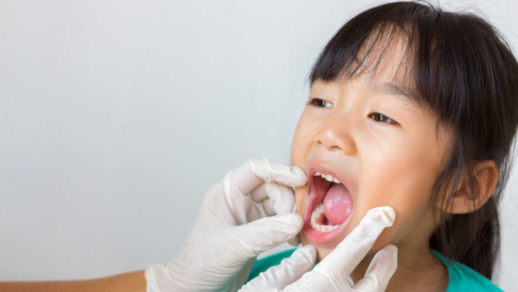 Lakowanie trzonowców zmniejsza ryzyko próchnicy