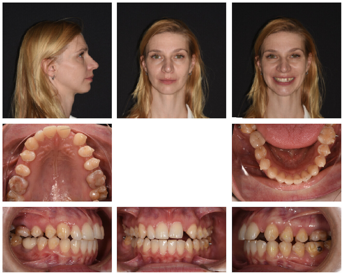 Fig. 6: Mid-treatment photographs showing the need for some corrections