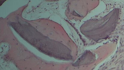 Aumento della cresta alveolare con tecnica “Bone into Bone”: analisi istomorfometrica