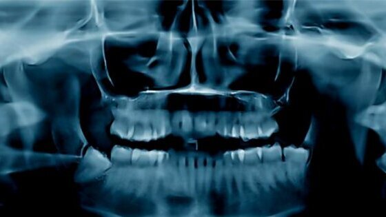 Osteonecrosi: una malattia che fa paura
