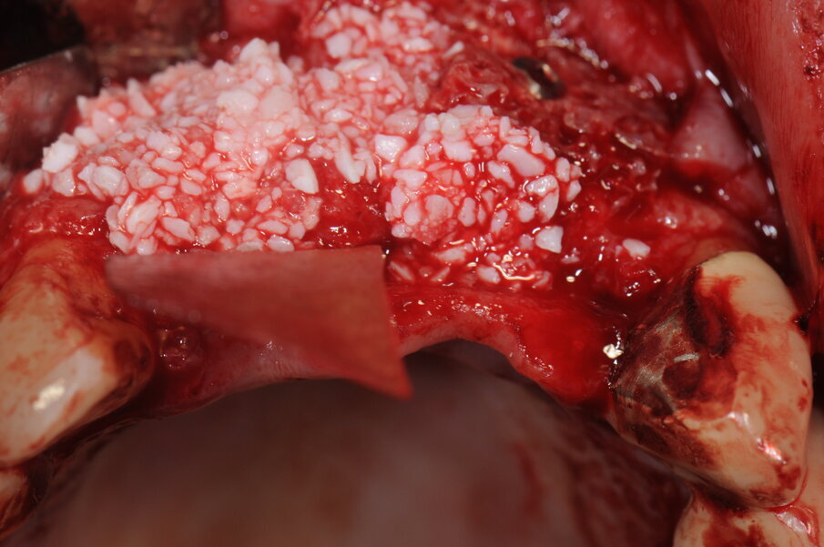 Fig. 9 - Fissaggio dell’onlay graft vestibolare e applicazione del riempitivo in granuli.