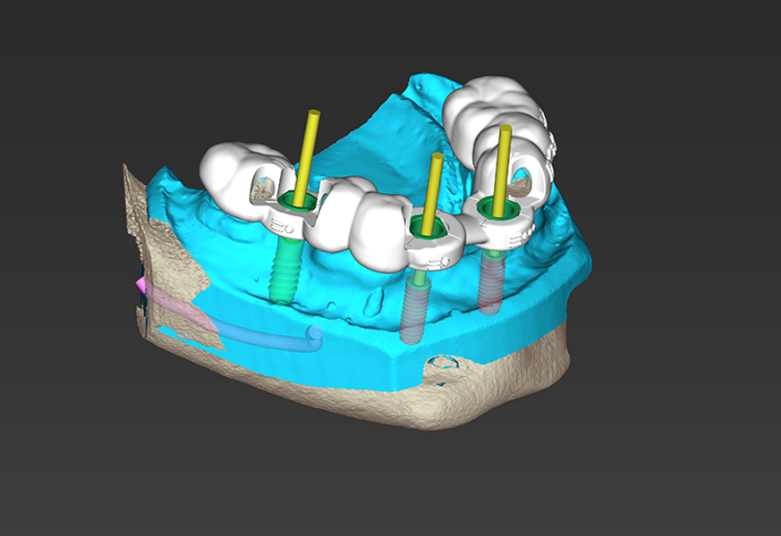 coDiagnostiX design the drill guide