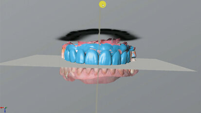 Nový úsměv za jeden den