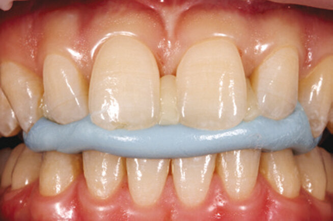 4. Pacijentov ugriz u silikon.