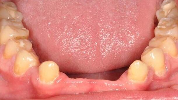 Leczenie ortodontyczne i implantoprotetyczne u pacjentów z dysplazją ektodermalną