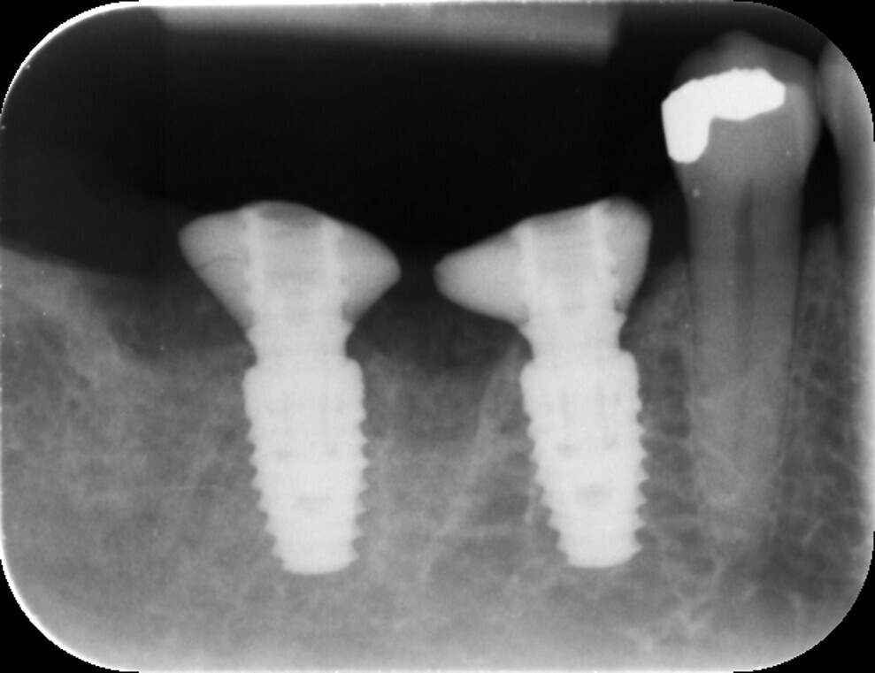 Fig. 12: Post-op radiograph.