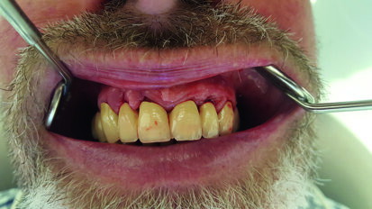 Trattamento efficace per la parodontite e la perimplantite con l’innovativa tecnologia a ossigeno