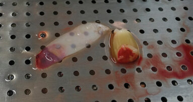 Efficace, indolore e senza  effetti collaterali o indesiderati: ecco i vantaggi della terapia con L-PRF