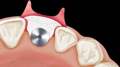 Analisi critica dei fattori di rischio estetici in implantologia post-estrattiva e introduzione di un nuovo parametro clinico-diagnostico