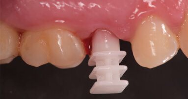 Impianto post-estrattivo a carico immediato in Zirconia