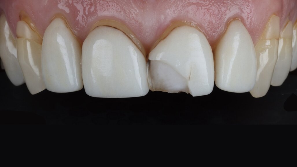 Glass-ceramic veneer cementation: Full adhesive workflow with PANAVIA Veneer LC