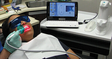 Detecting caries at the margins of restorations with The Canary System