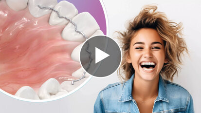 Dentaurum – prime4me RETAIN3R / La 3e Dimension fait la différence