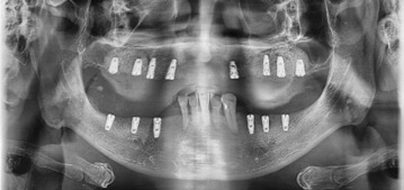  Figs. 4b: Post-treatment panoramic radiographs.